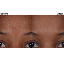 Porevac™ Facial Pore Cleanser